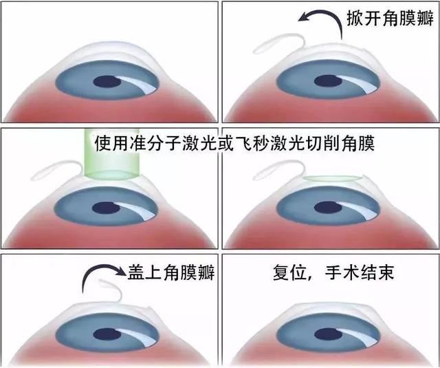 全飞秒手术过程